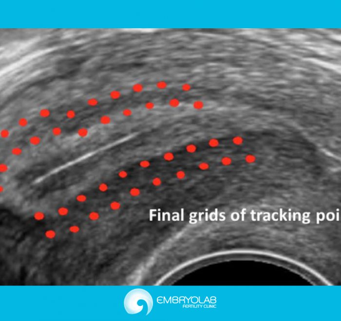 Speckle-Tracking Technology. All the latest in the Ultrasonic Assessment of Uterine Contractility